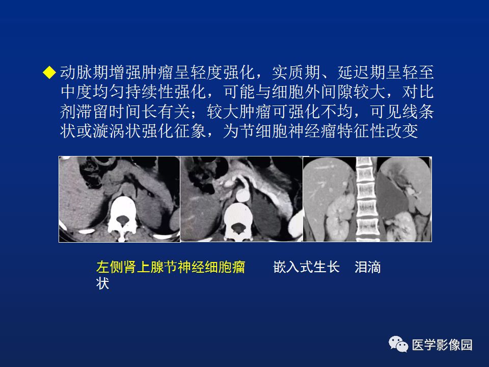 【PPT】肾上腺疾病的影像学表现