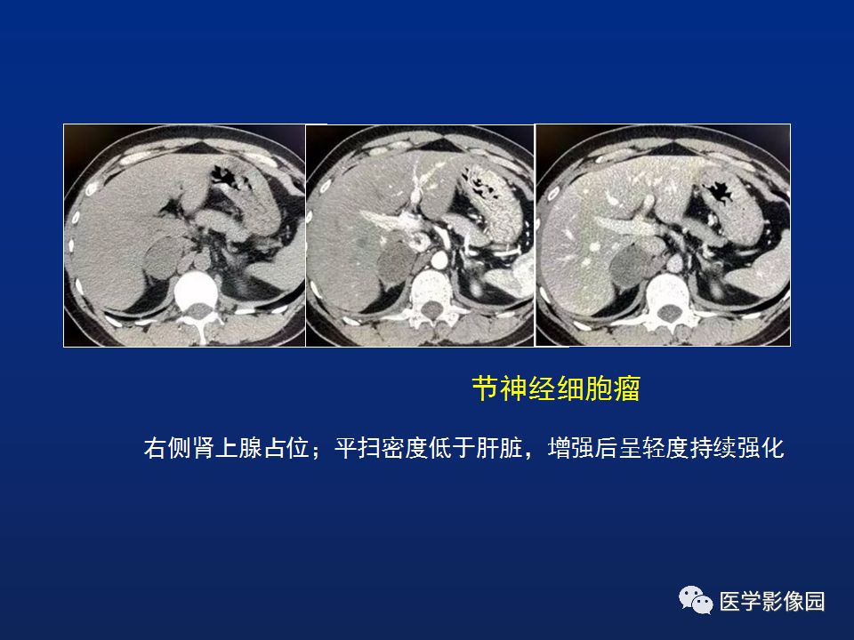 【PPT】肾上腺疾病的影像学表现