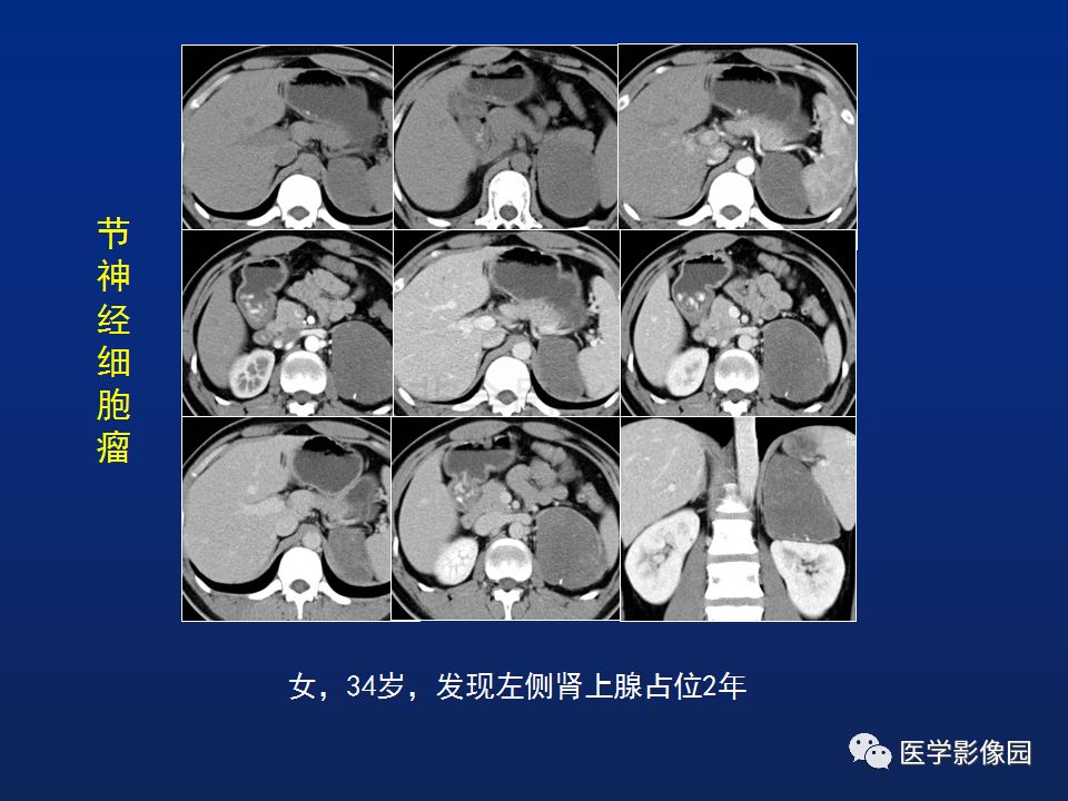 【PPT】肾上腺疾病的影像学表现
