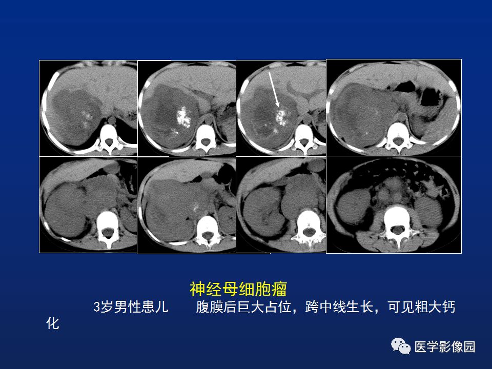 【PPT】肾上腺疾病的影像学表现