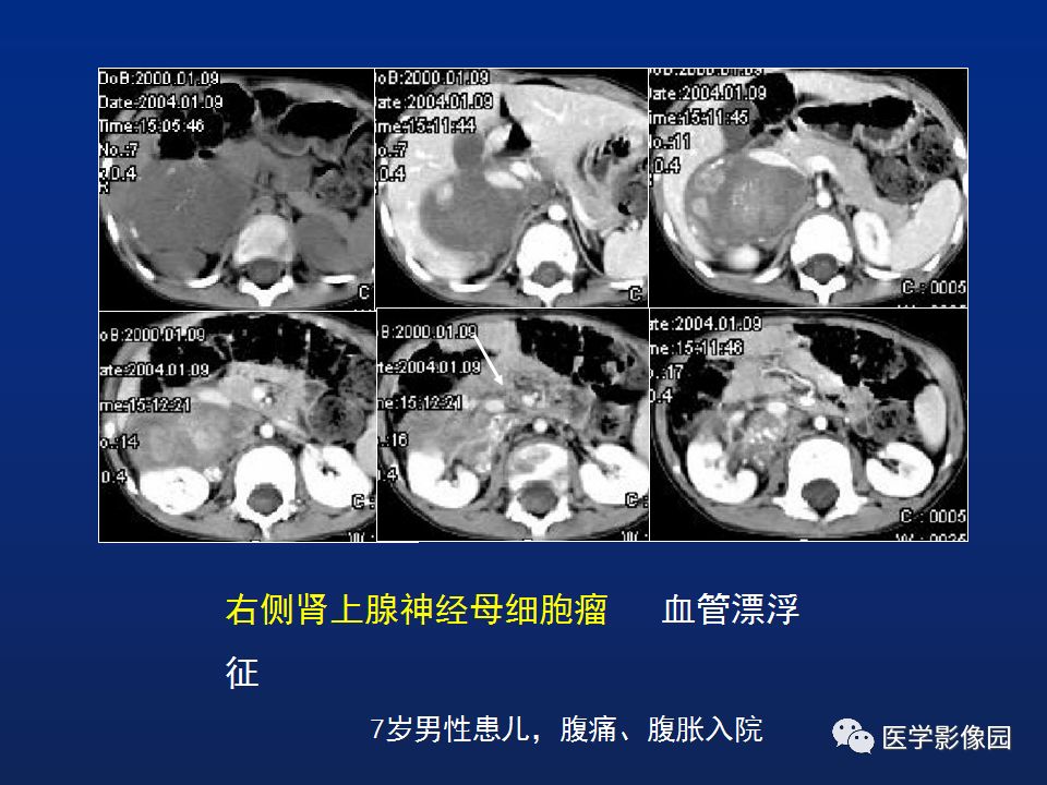 【PPT】肾上腺疾病的影像学表现