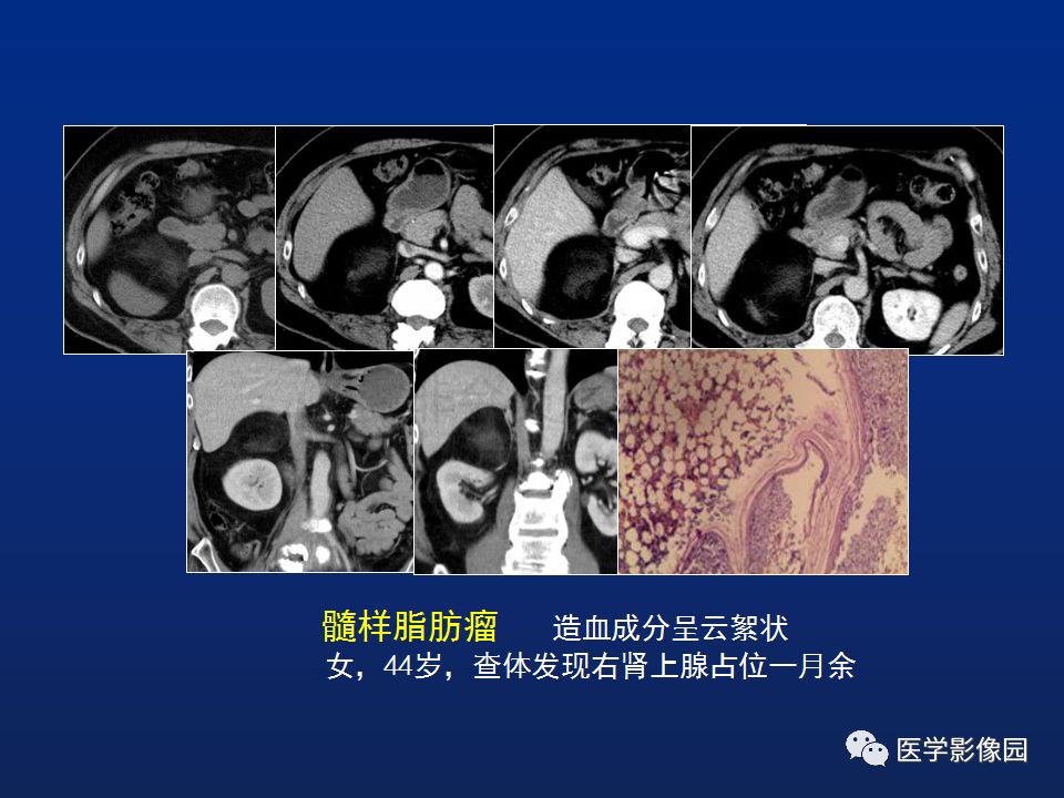 【PPT】肾上腺疾病的影像学表现