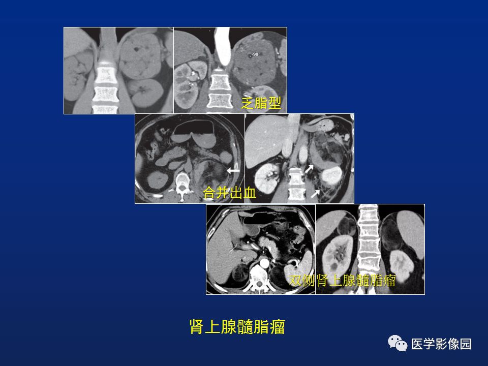 【PPT】肾上腺疾病的影像学表现