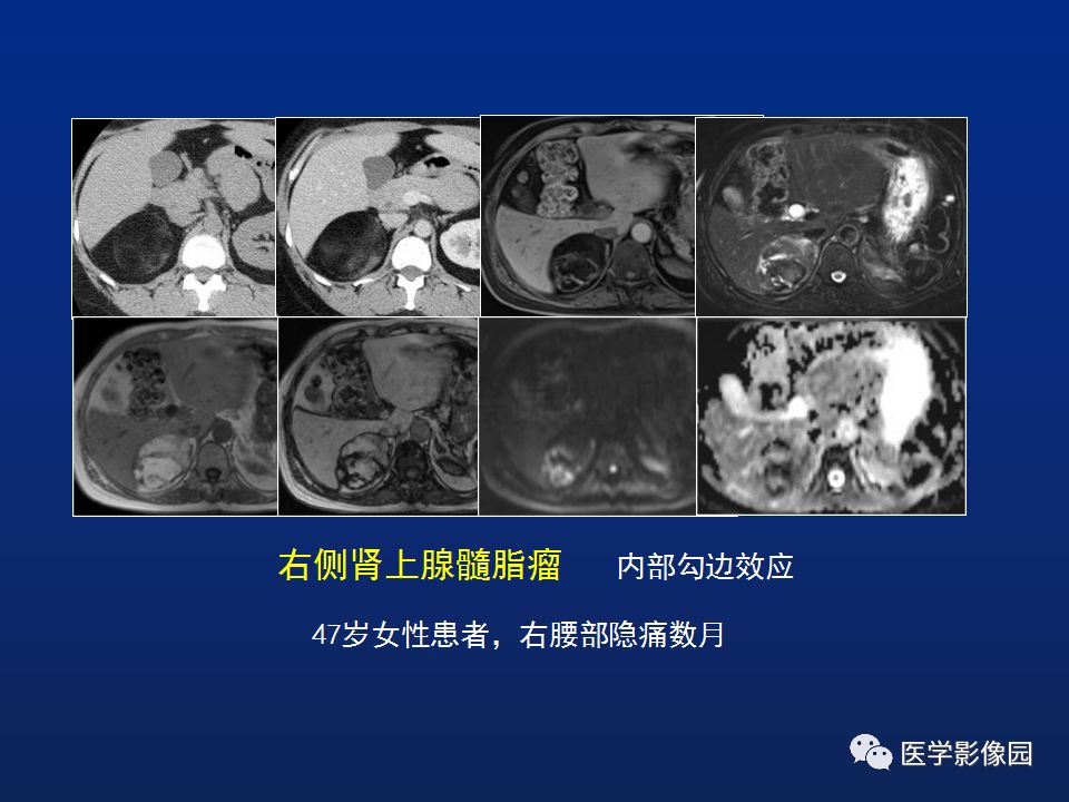 【PPT】肾上腺疾病的影像学表现