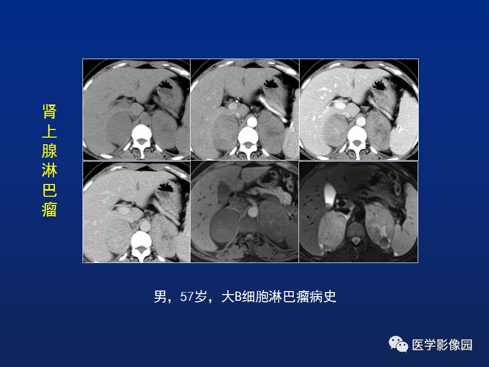 【PPT】肾上腺疾病的影像学表现