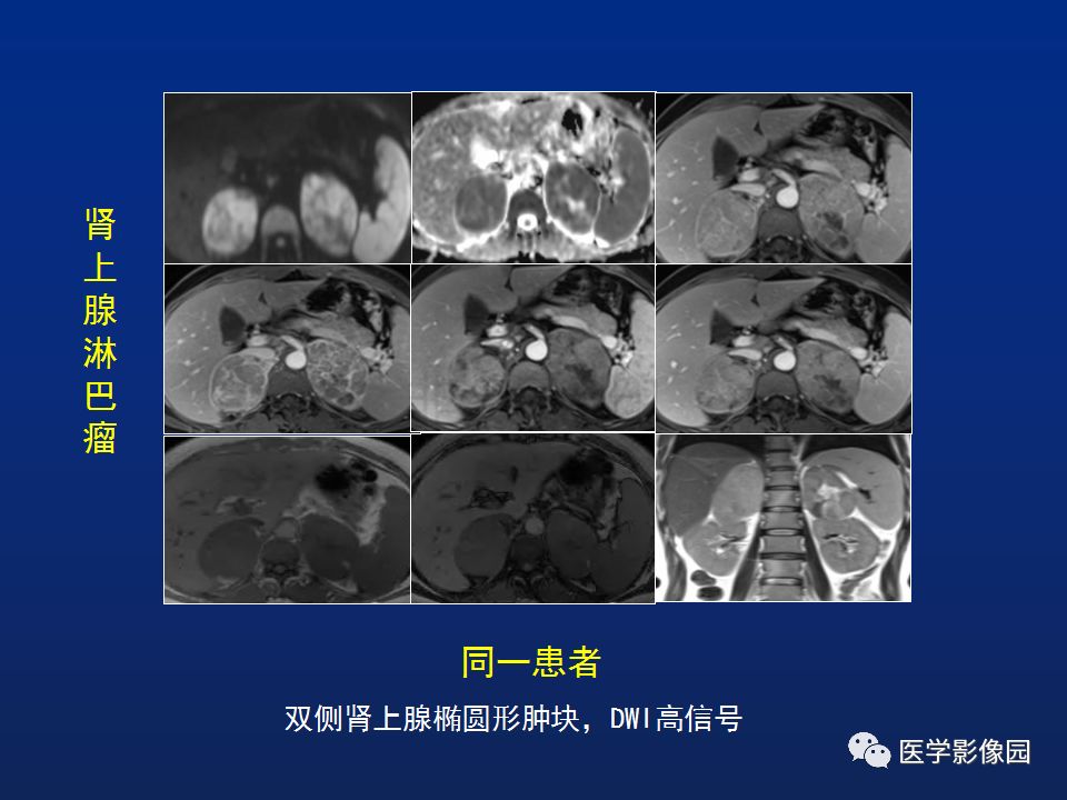 【PPT】肾上腺疾病的影像学表现