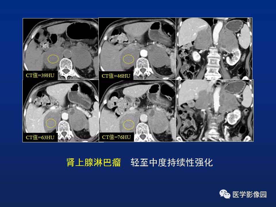 【PPT】肾上腺疾病的影像学表现