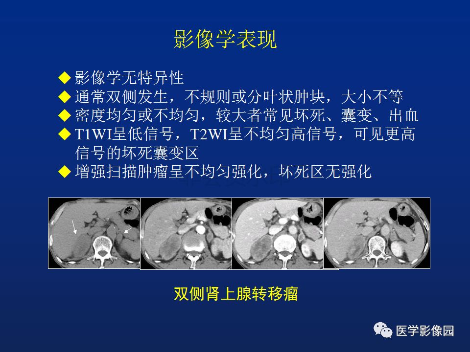 【PPT】肾上腺疾病的影像学表现