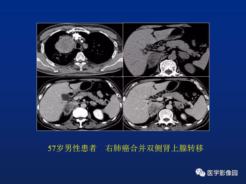 【PPT】肾上腺疾病的影像学表现