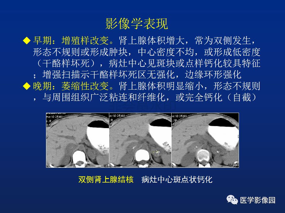 【PPT】肾上腺疾病的影像学表现