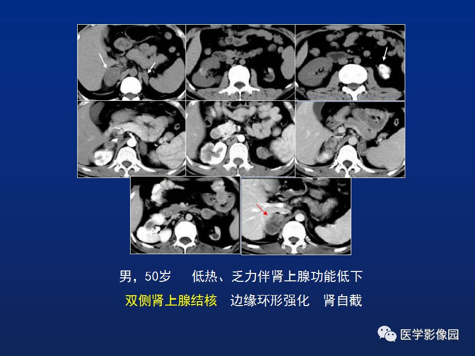 【PPT】肾上腺疾病的影像学表现