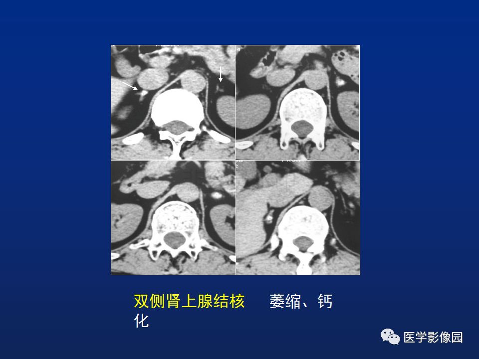 【PPT】肾上腺疾病的影像学表现