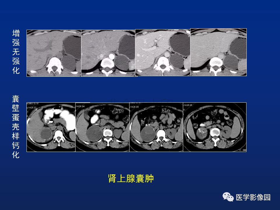 【PPT】肾上腺疾病的影像学表现