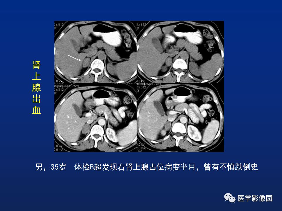 【PPT】肾上腺疾病的影像学表现