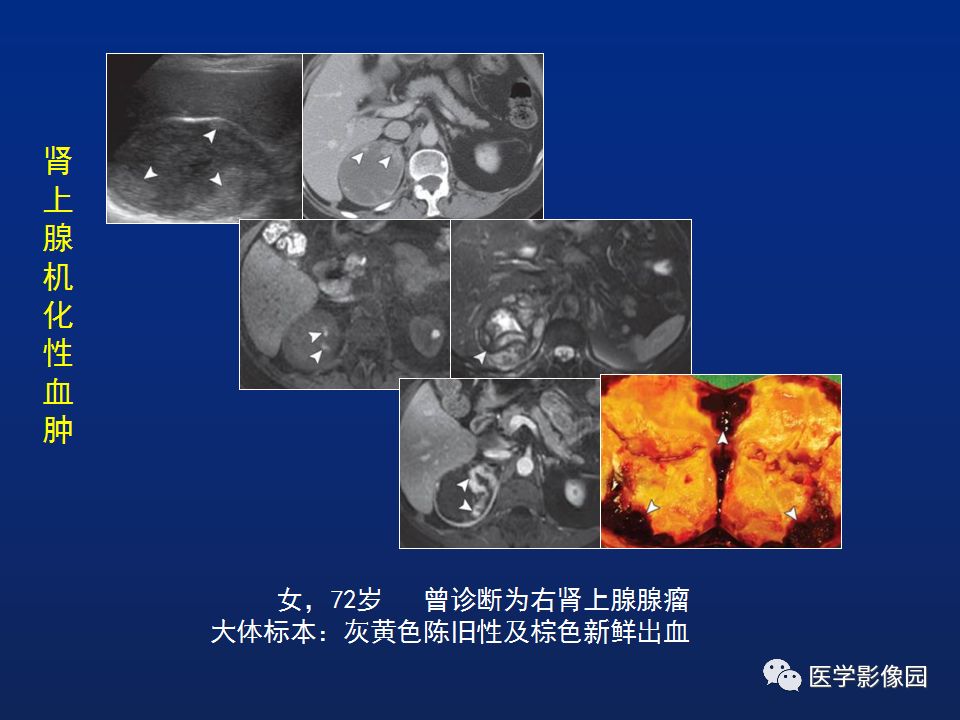 【PPT】肾上腺疾病的影像学表现