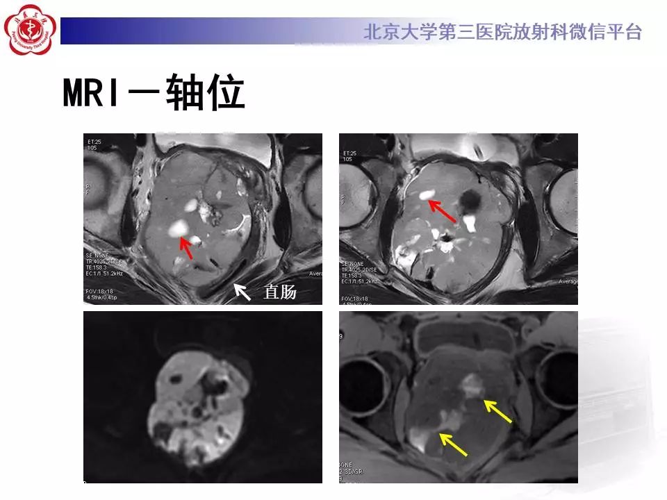 【病例】前列腺肉瘤1例MR