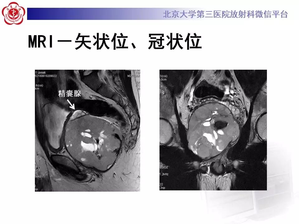 【病例】前列腺肉瘤1例MR