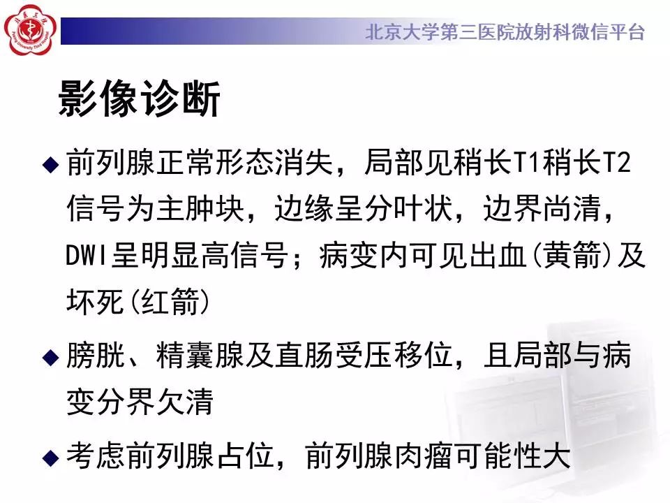 【病例】前列腺肉瘤1例MR