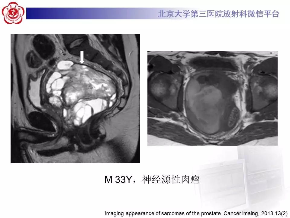 【病例】前列腺肉瘤1例MR