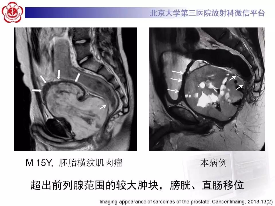 【病例】前列腺肉瘤1例MR