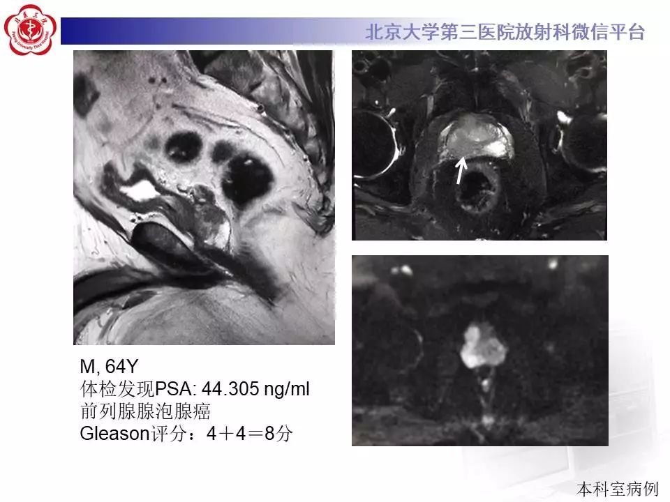 【病例】前列腺肉瘤1例MR