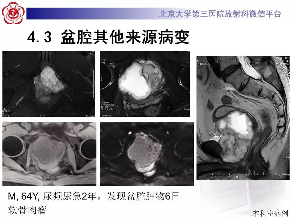 【病例】前列腺肉瘤1例MR