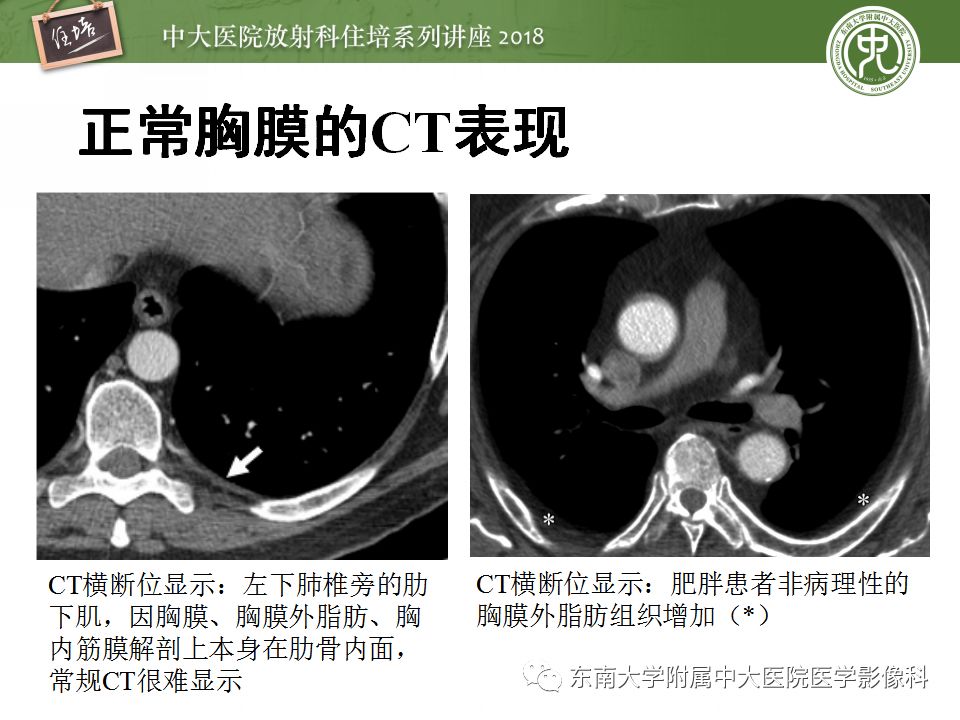 【PPT】胸膜常见疾病的影像诊断
