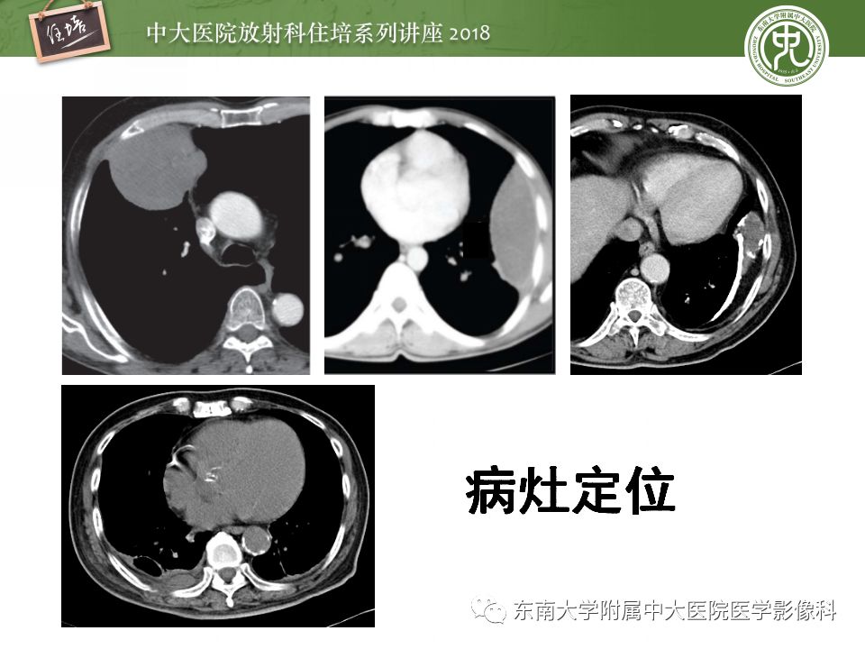 【PPT】胸膜常见疾病的影像诊断