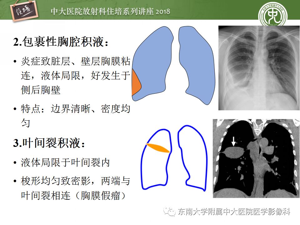 【PPT】胸膜常见疾病的影像诊断