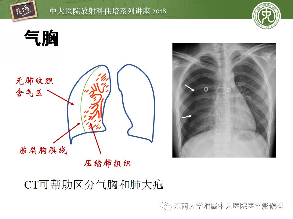 【PPT】胸膜常见疾病的影像诊断