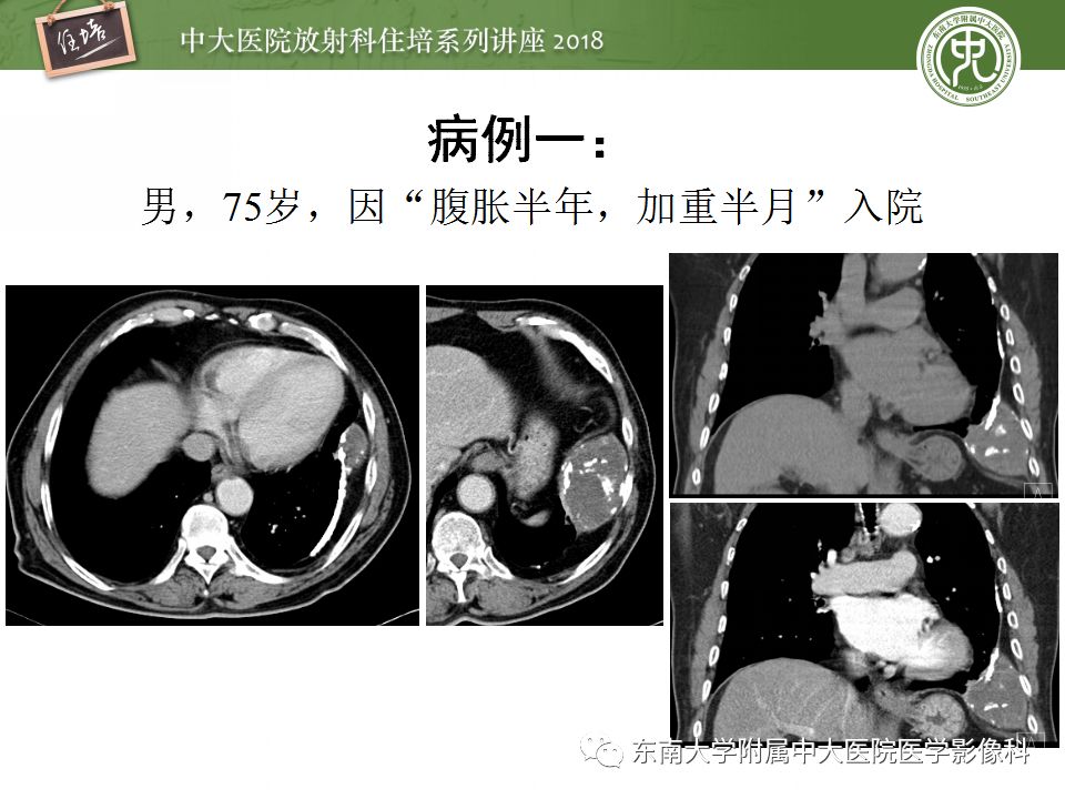 【PPT】胸膜常见疾病的影像诊断