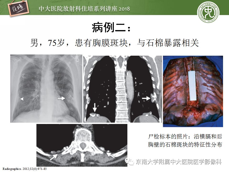 【PPT】胸膜常见疾病的影像诊断