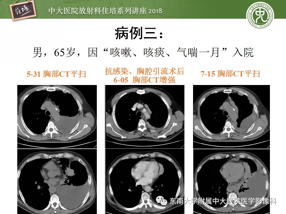 【PPT】胸膜常见疾病的影像诊断