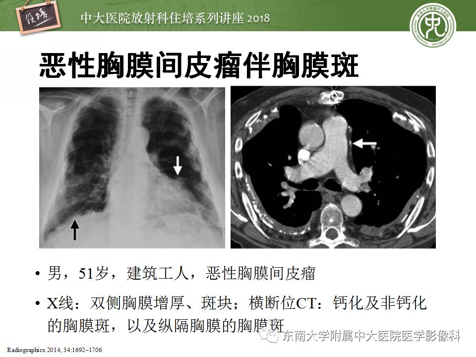【PPT】胸膜常见疾病的影像诊断