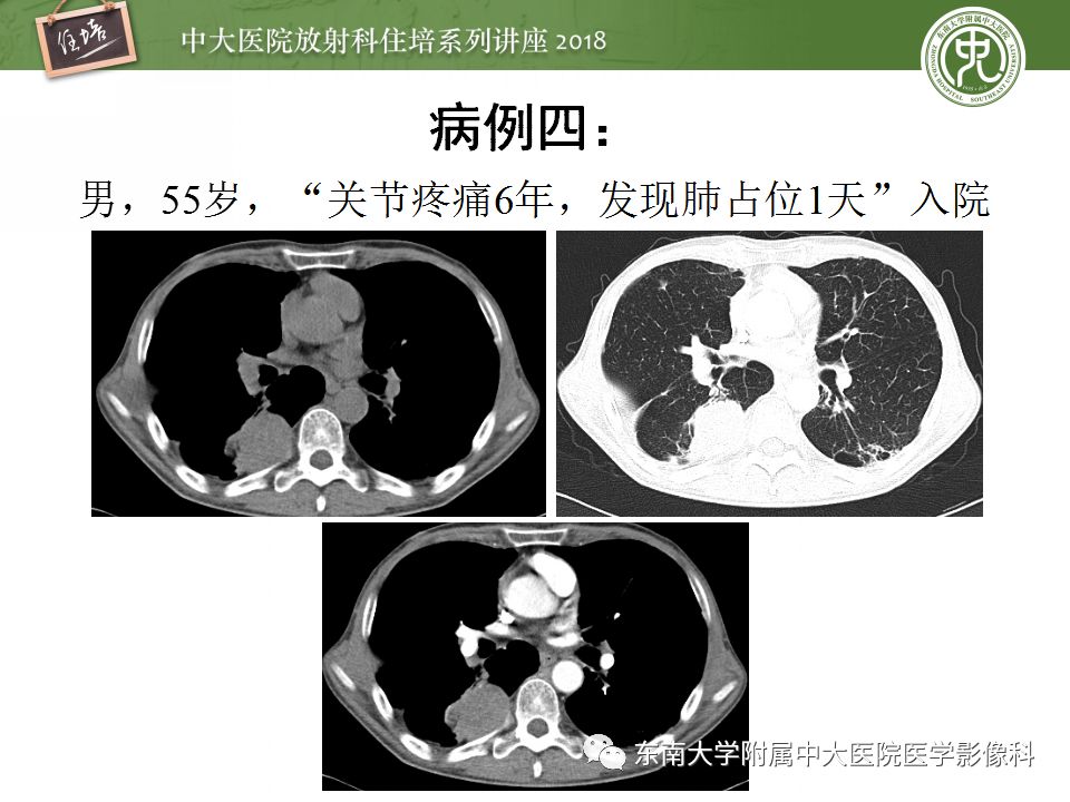 【PPT】胸膜常见疾病的影像诊断
