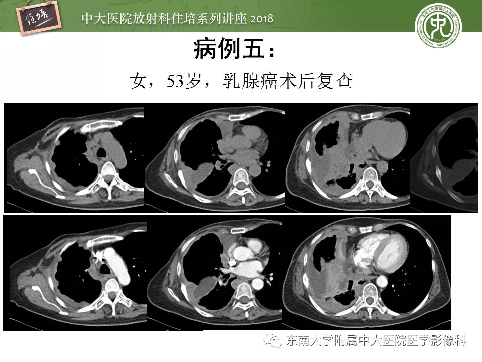 【PPT】胸膜常见疾病的影像诊断
