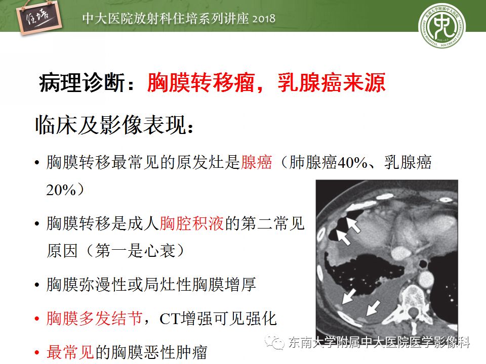 【PPT】胸膜常见疾病的影像诊断
