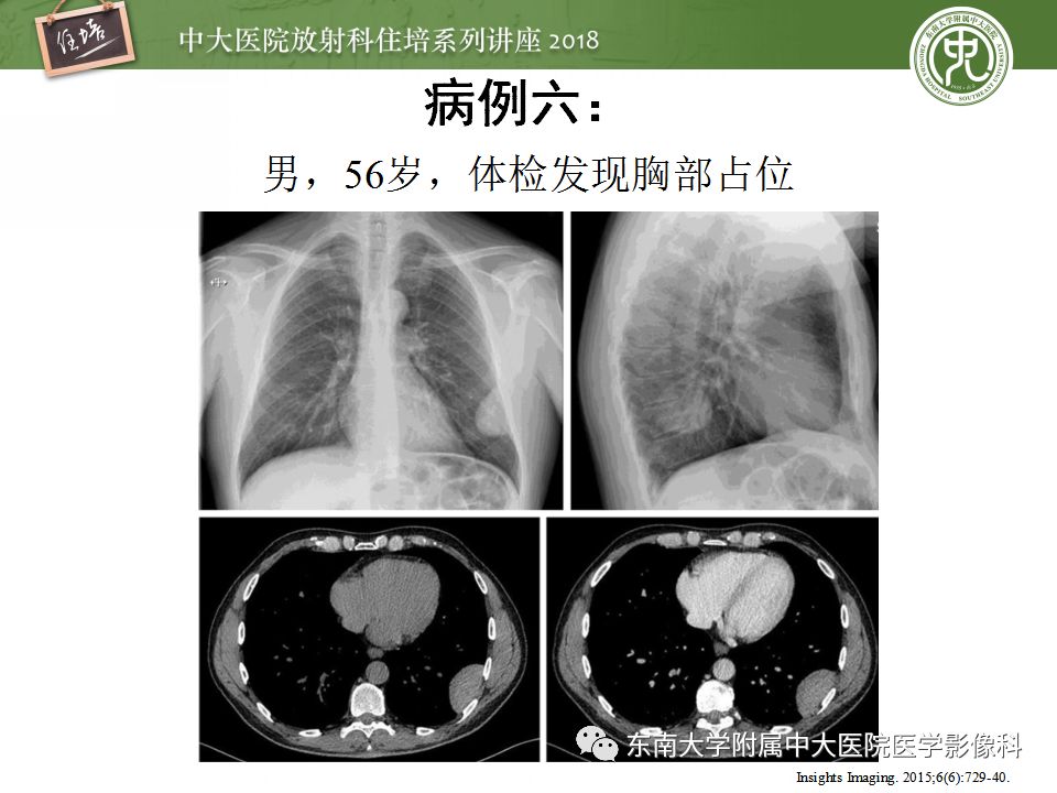【PPT】胸膜常见疾病的影像诊断