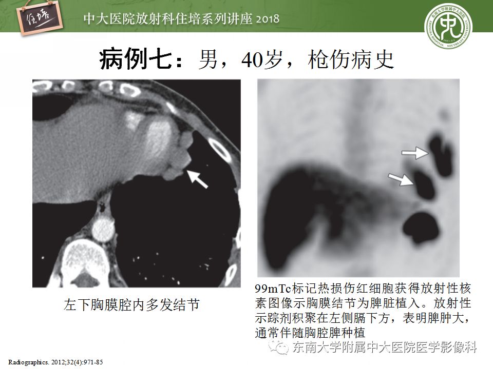 【PPT】胸膜常见疾病的影像诊断