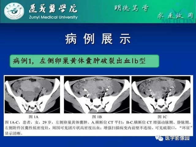 【PPT】卵巢良性囊性病变的CT、MRI表现