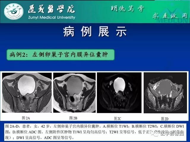 【PPT】卵巢良性囊性病变的CT、MRI表现