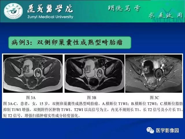 【PPT】卵巢良性囊性病变的CT、MRI表现
