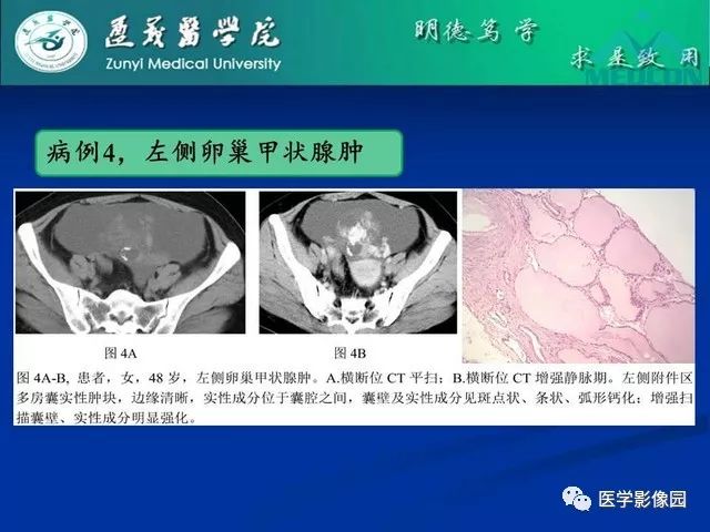 【PPT】卵巢良性囊性病变的CT、MRI表现