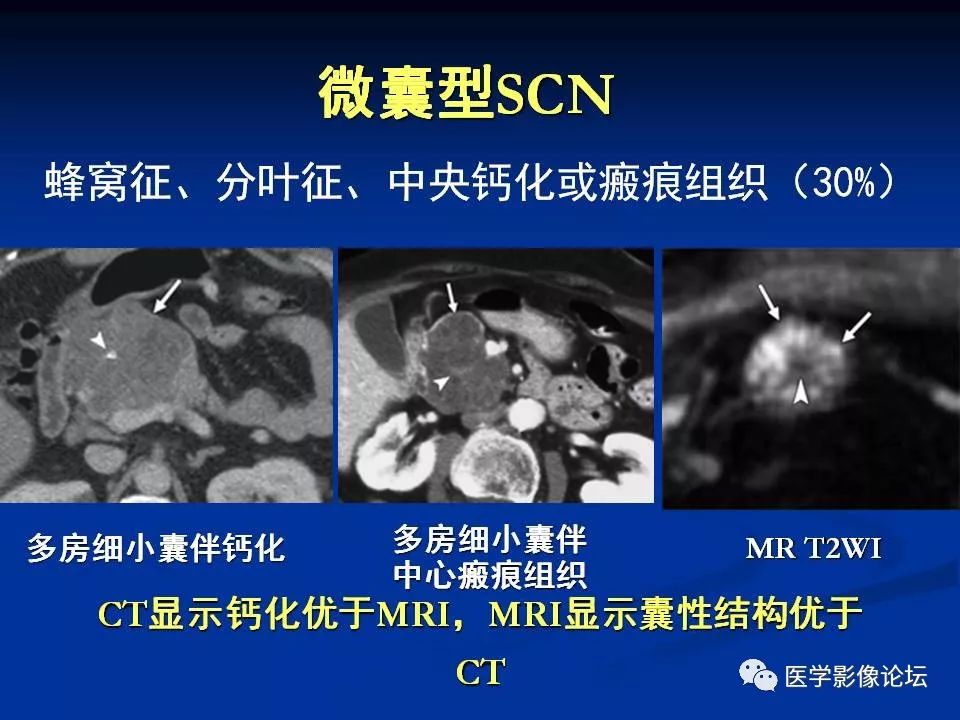 【PPT】胰腺囊性肿瘤影像学诊断与鉴别诊断