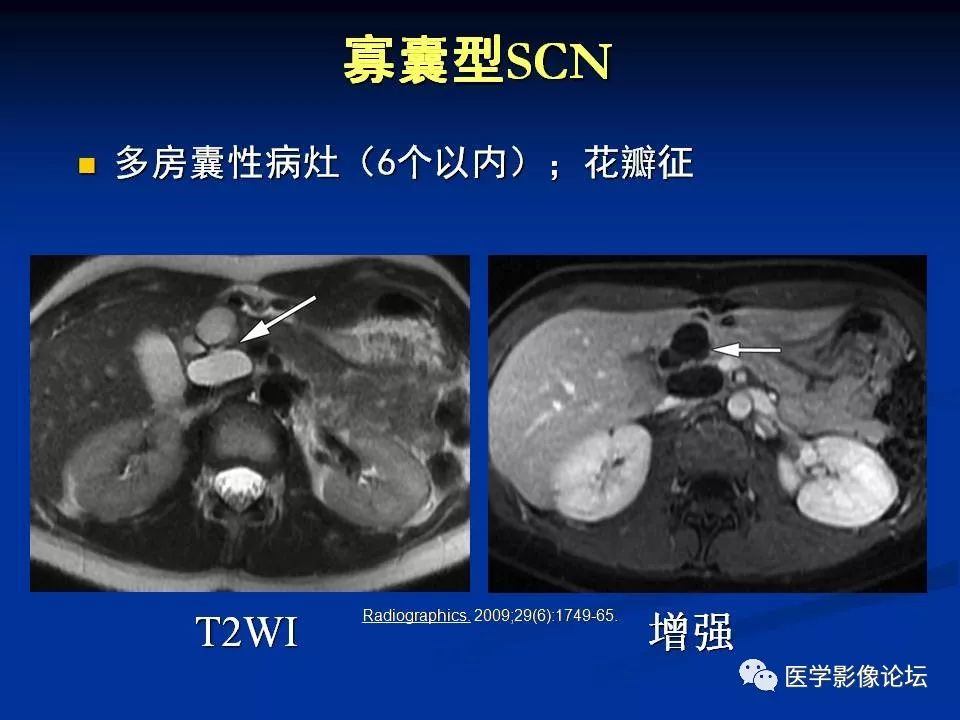 【PPT】胰腺囊性肿瘤影像学诊断与鉴别诊断