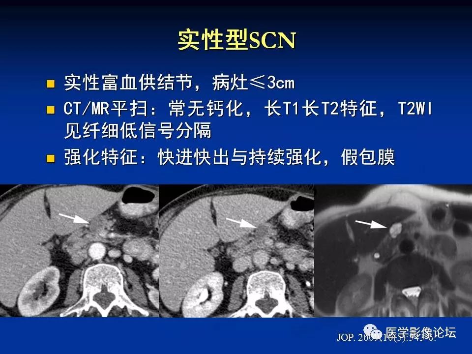 【PPT】胰腺囊性肿瘤影像学诊断与鉴别诊断