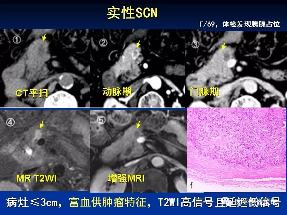 【PPT】胰腺囊性肿瘤影像学诊断与鉴别诊断