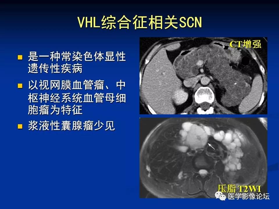 【PPT】胰腺囊性肿瘤影像学诊断与鉴别诊断