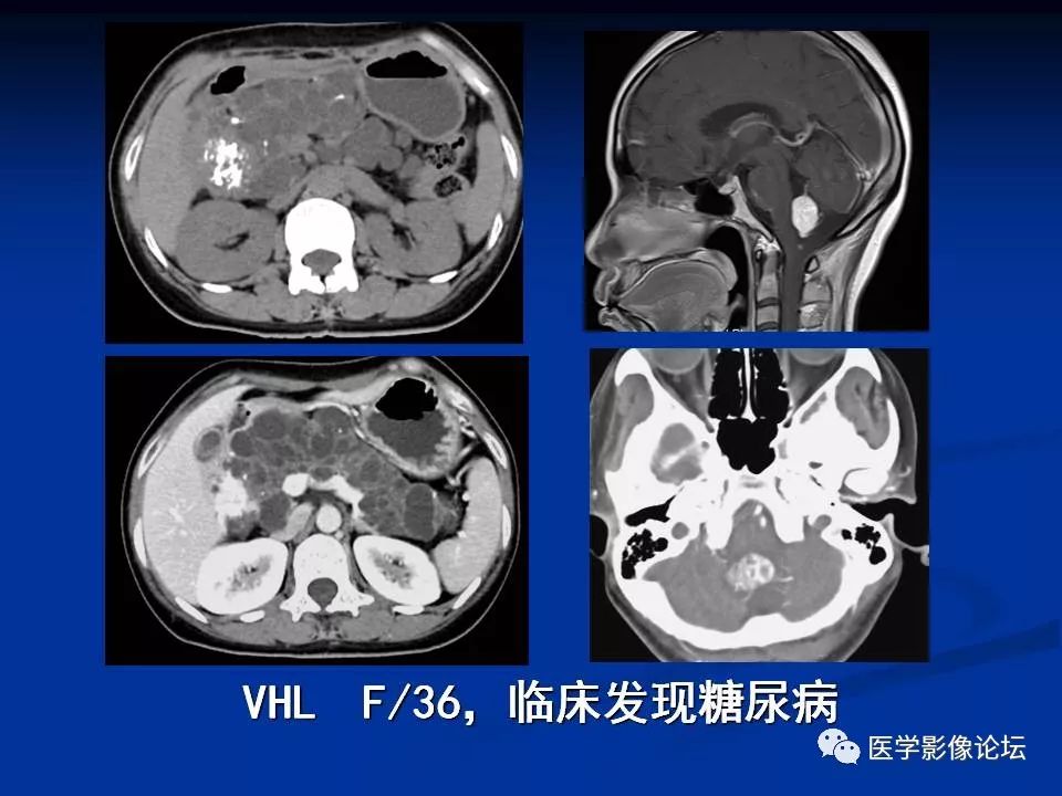 【PPT】胰腺囊性肿瘤影像学诊断与鉴别诊断