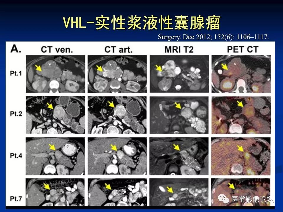 【PPT】胰腺囊性肿瘤影像学诊断与鉴别诊断